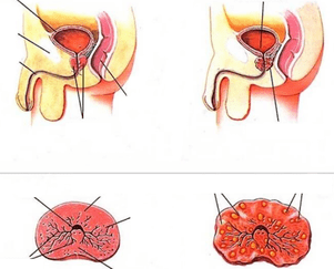 próstata normal y prostatitis crónica