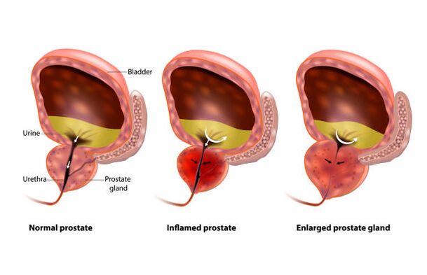 la prostatitis es una inflamación de la glándula prostática